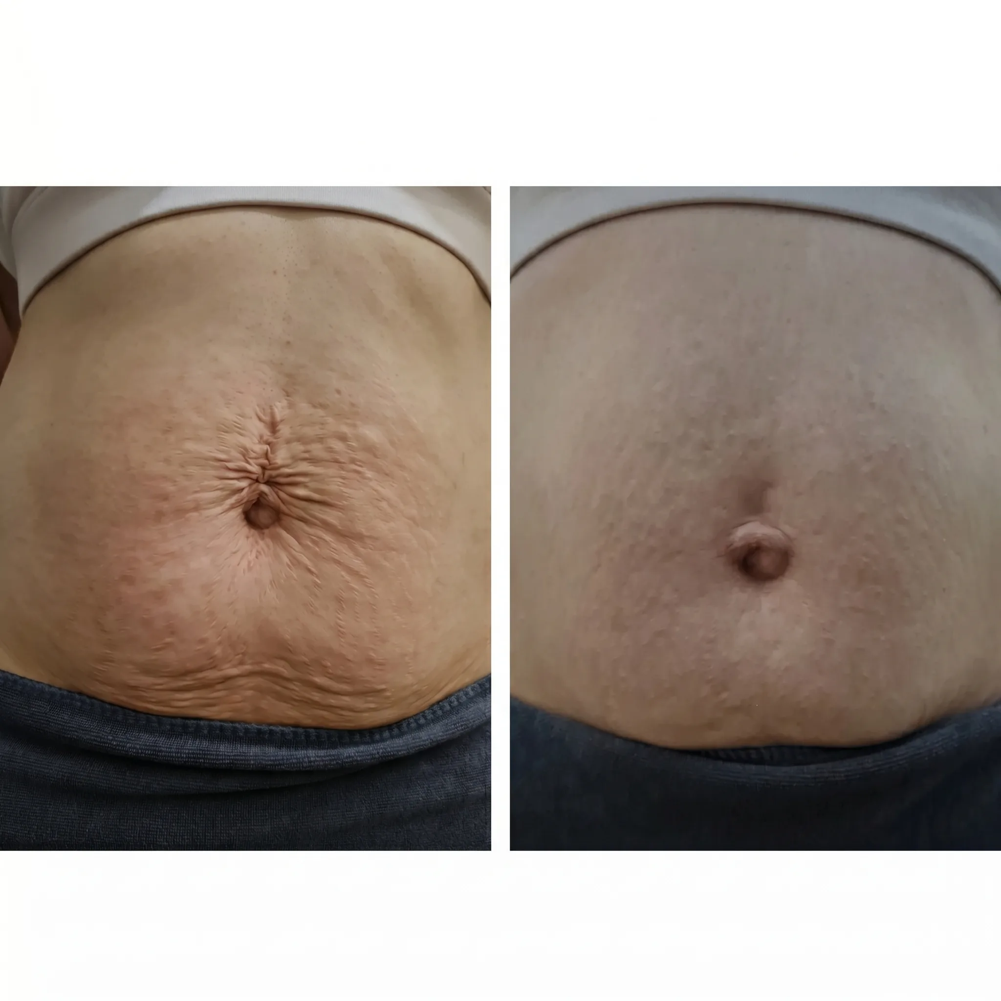 Emsculpt RF Body Contouring Before and After Results