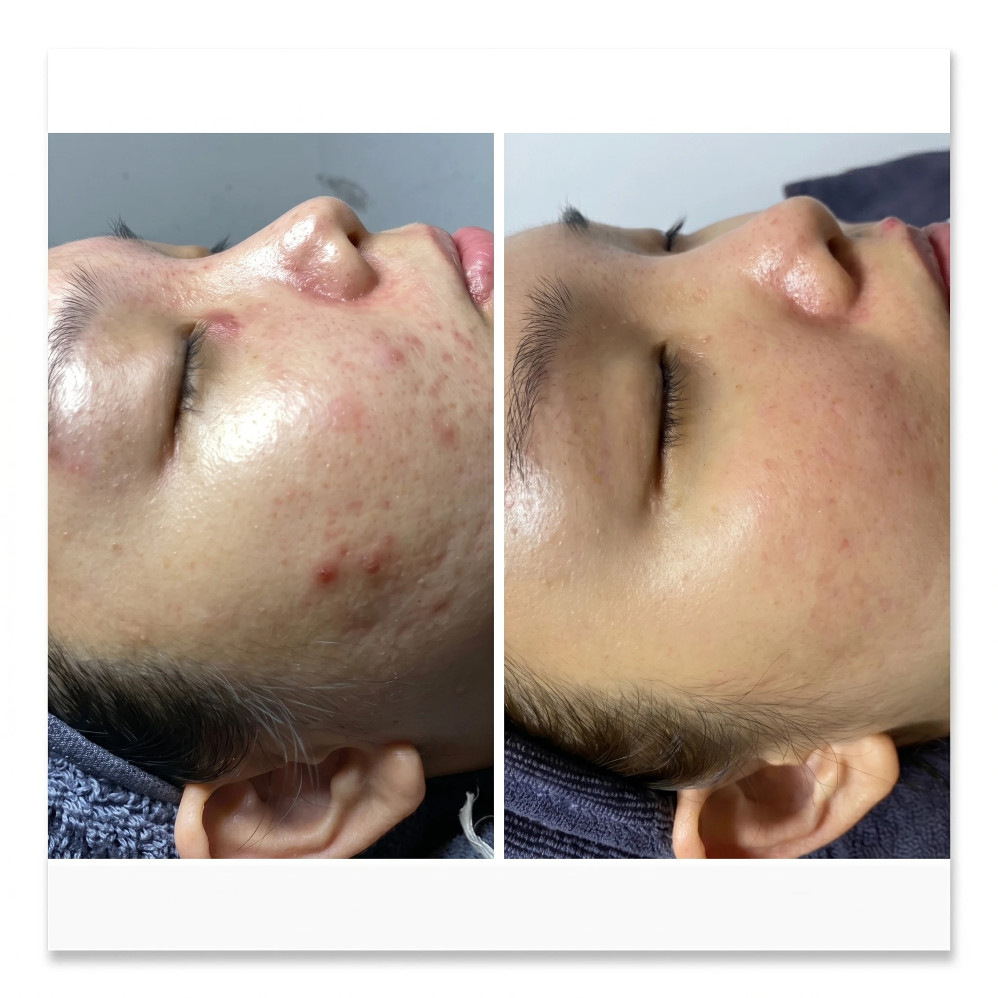 Acne Treatment Before and After Results