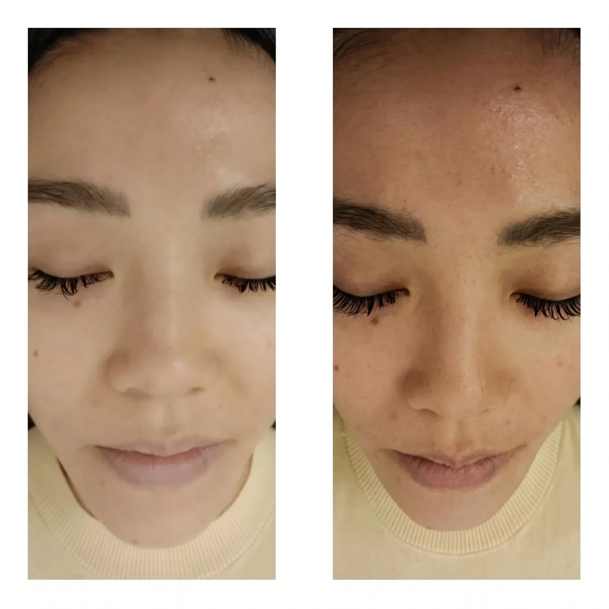 Aqua Hydro Facial Before and After Results