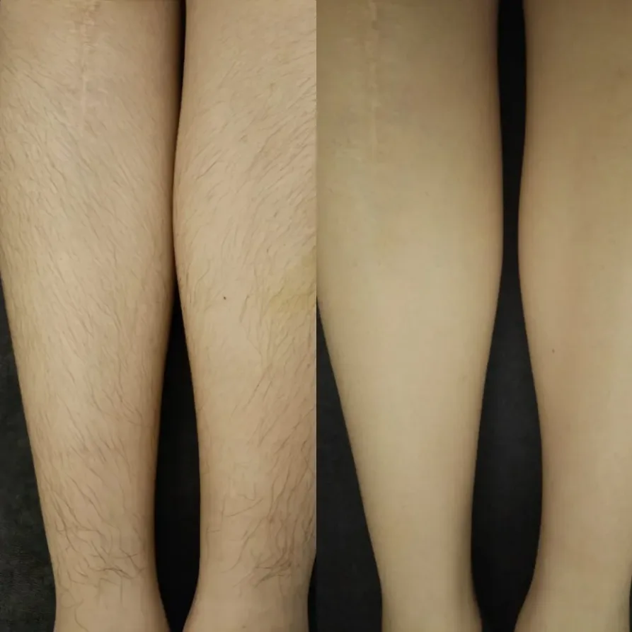 SHR Full Leg Hair Removal Before and After