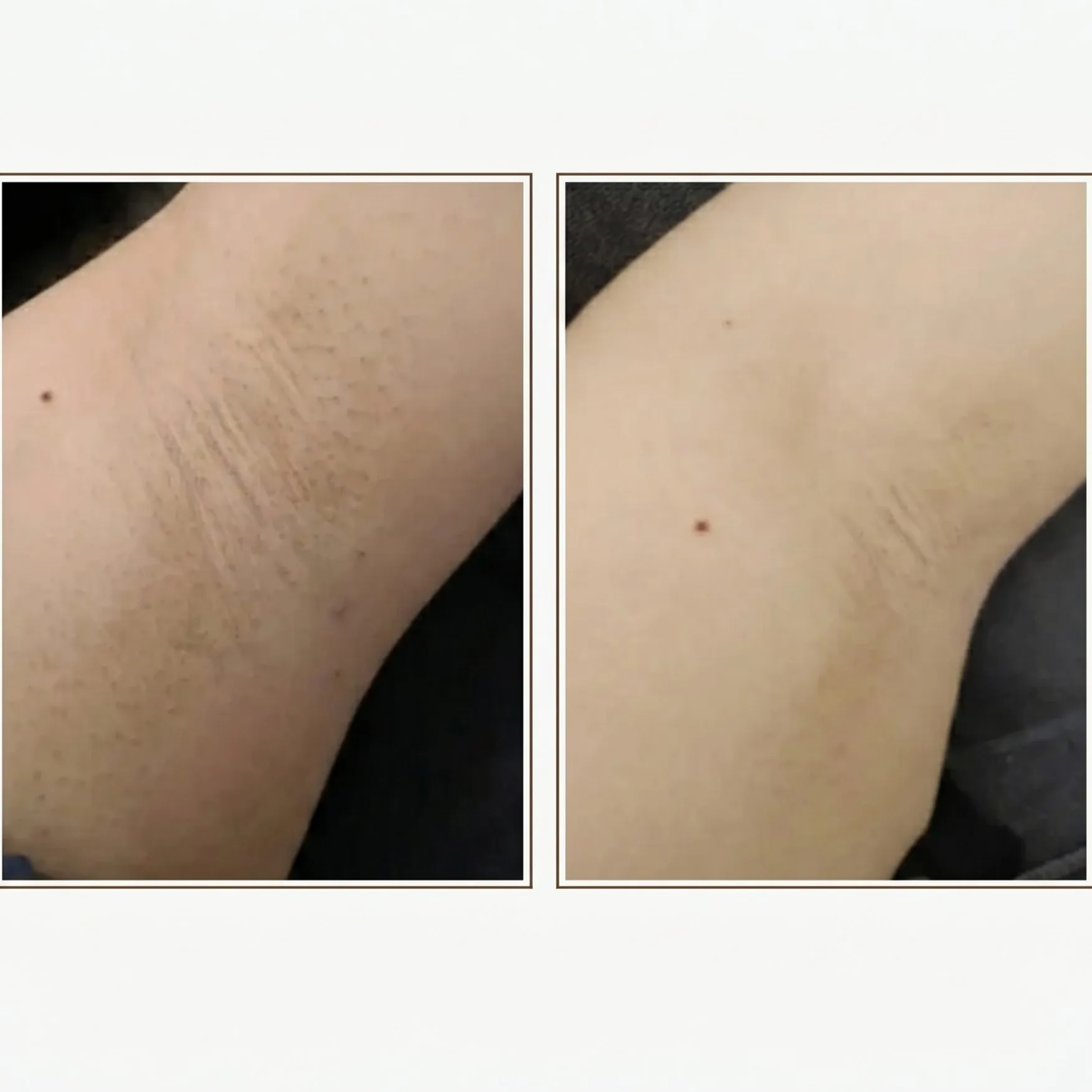 SHR Underarm Hair Removal Before and After