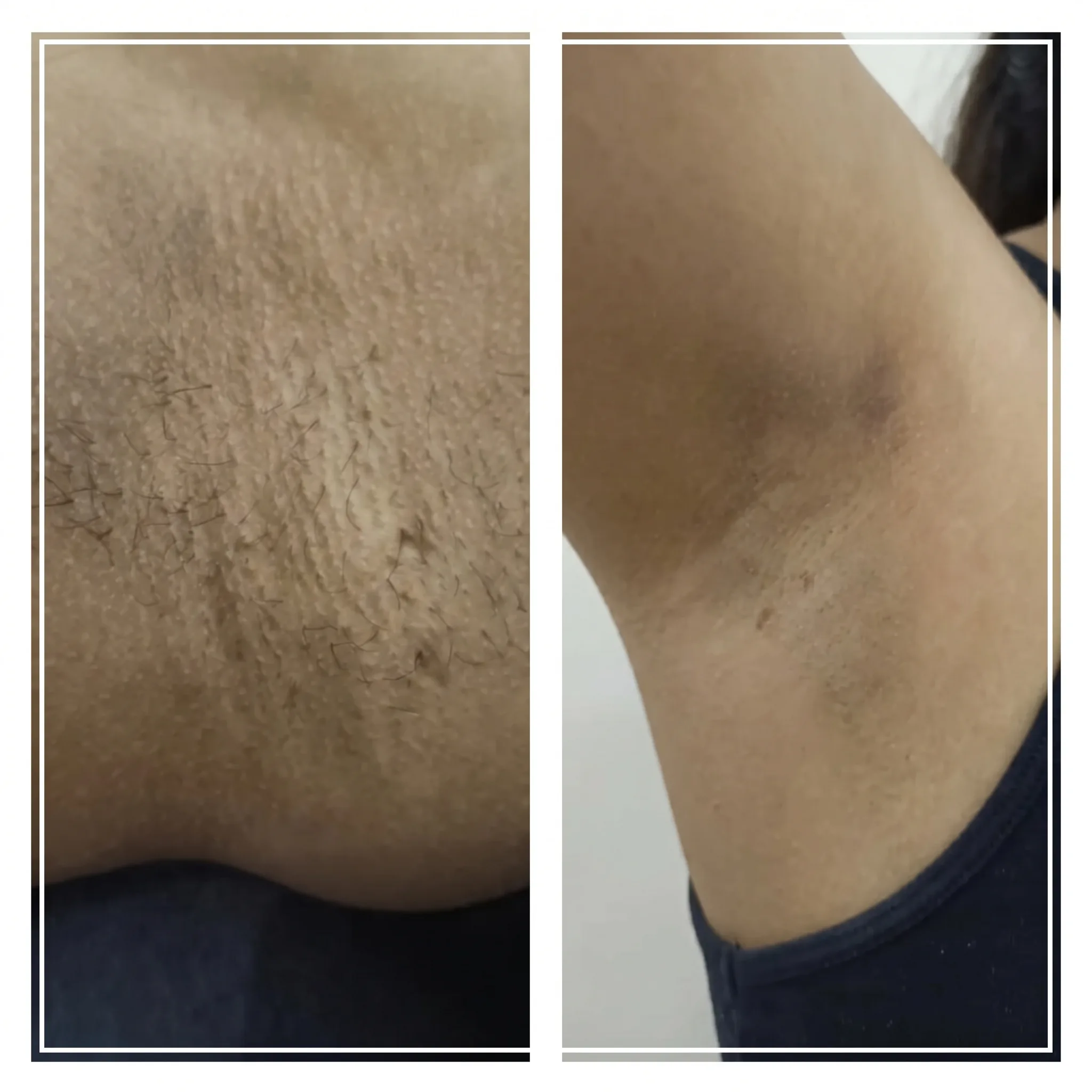 SHR Whitening and Hair Removal Before and After